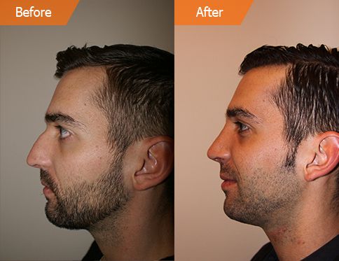 Male face, Before and After Plastic Surgery Treatment, right side view, patient 1
