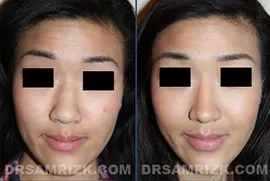 23 year old Asian patient wanted to add definition to her face by undergoing a rhinoplasty. Dr. Rizk performed the rhinoplasty with auricular graft to give her more definition. The auricular graft was necessary as the patient’s own septum was too thin for creating sufficient definition in her nose. The set of pictures is shown one year after her procedure.