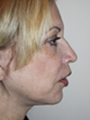 Facelift New York