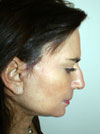 Facelift NYC