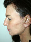 Facelift NYC