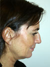 Facelift NYC