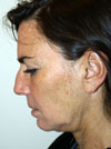Facelift NYC