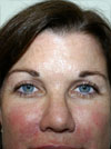 Eyelid Surgery NYC