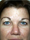 Eyelid Surgery NYC
