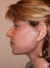 Facelift NYC