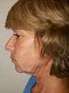 Facelift NYC