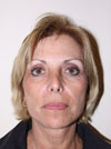 Facelift NYC