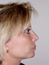 Facelift NYC