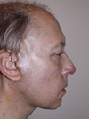1 Week After Surgery