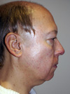 Before Surgery