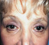 Eyelid Surgery NYC