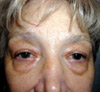 Eyelid Surgery NYC