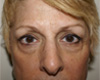 Eyelid Surgery NYC