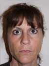 Facelift New York
