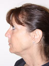 Facelift New York