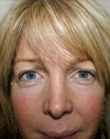 Eyelid Surgery NYC