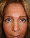 Eyelid Surgery NYC