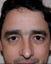 Eyelid Surgery NYC