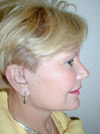 Facelift New York