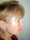 Facelift New York