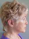 Facelift New York