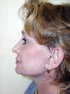 Facelift NYC
