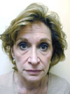 Facelift NYC