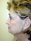 Facelift NYC