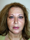 Facelift New York