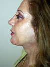 Facelift New York