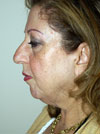 Facelift New York