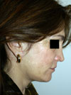 Facelift NYC