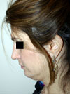 Facelift NYC
