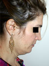 Facelift NYC