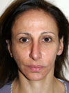 Facelift NYC