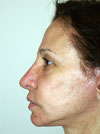 Facelift NYC