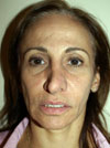 Facelift NYC