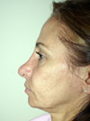 Facelift NYC
