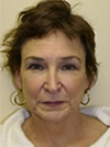 Facelift New York
