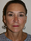 Facelift New York