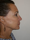 Facelift New York