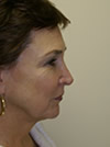 Facelift New York