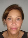 Facelift NYC