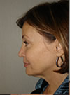 Facelift NYC