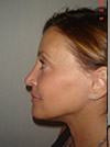 Facelift NYC