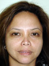 Nose Job NYC