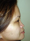 Nose Job NYC