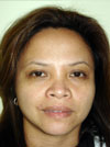 Nose Job NYC