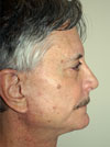 Facelift NYC